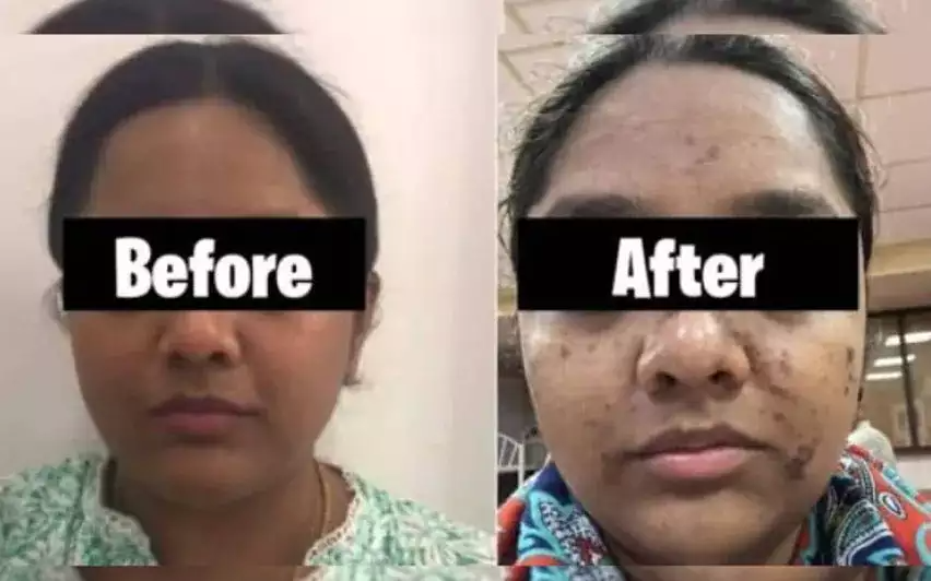 facial-beauty-steam-case-loss